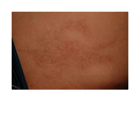 Tatuaż po zabiegu laserowym fot.2 Shar-pol-005-2014-09-04 _ 20_55_50-80